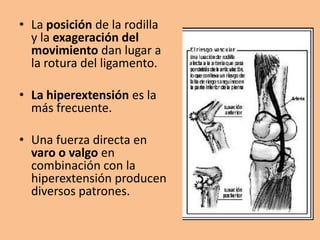 • La posición de la rodilla
  y la exageración del
  movimiento dan lugar a
  la rotura del ligamento.

• La hiperextensión es la
  más frecuente.

• Una fuerza directa en
  varo o valgo en
  combinación con la
  hiperextensión producen
  diversos patrones.
 