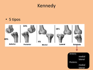 Kennedy

 • 5 tipos
             33%
                             18%



40%
                   4%




                                   Antero:
                                              medial
                                              lateral
                                   Postero:
                                              medial
                                              lateral
 