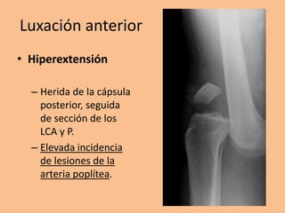 Luxación anterior
• Hiperextensión

  – Herida de la cápsula
    posterior, seguida
    de sección de los
    LCA y P.
  – Elevada incidencia
    de lesiones de la
    arteria poplítea.
 