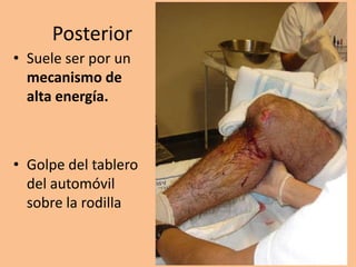 Posterior
• Suele ser por un
  mecanismo de
  alta energía.



• Golpe del tablero
  del automóvil
  sobre la rodilla
 