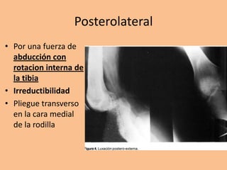 Posterolateral
• Por una fuerza de
  abducción con
  rotacion interna de
  la tibia
• Irreductibilidad
• Pliegue transverso
  en la cara medial
  de la rodilla
 