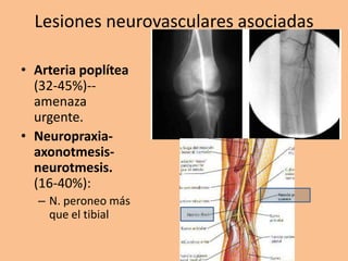 Lesiones neurovasculares asociadas

• Arteria poplítea
  (32-45%)--
  amenaza
  urgente.
• Neuropraxia-
  axonotmesis-
  neurotmesis.
  (16-40%):
  – N. peroneo más
    que el tibial
 