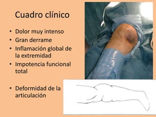 Cuadro clínico
• Dolor muy intenso
• Gran derrame
• Inflamación global de
  la extremidad
• Impotencia funcional
  total

• Deformidad de la
  articulación
 