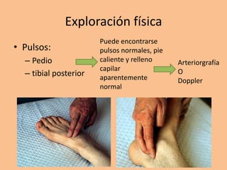 Exploración física
                       Puede encontrarse
• Pulsos:              pulsos normales, pie
  – Pedio              caliente y relleno     Arteriorgrafía
                       capilar
  – tibial posterior   aparentemente
                                              O
                                              Doppler
                       normal
 