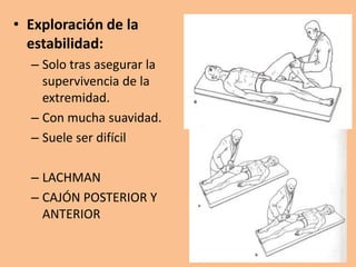 • Exploración de la
  estabilidad:
  – Solo tras asegurar la
    supervivencia de la
    extremidad.
  – Con mucha suavidad.
  – Suele ser difícil

  – LACHMAN
  – CAJÓN POSTERIOR Y
    ANTERIOR
 