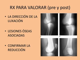 RX PARA VALORAR (pre y post)
• LA DIRECCIÓN DE LA
  LUXACIÓN

• LESIONES ÓSEAS
  ASOCIADAS

• CONFIRMAR LA
  REDUCCIÓN
 