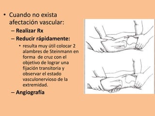 • Cuando no exista
  afectación vascular:
  – Realizar Rx
  – Reducir rápidamente:
     • resulta muy útil colocar 2
       alambres de Steinmann en
       forma de cruz con el
       objetivo de lograr una
       fijación transitoria y
       observar el estado
       vasculonervioso de la
       extremidad.
  – Angiografía
 