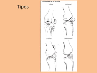 Tipos
 