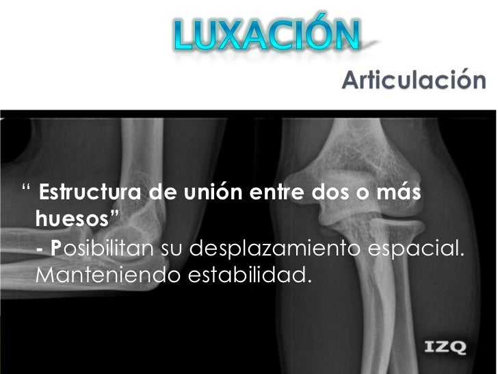 Luxacion