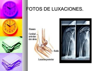 FOTOS DE LUXACIONES.