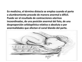 TRACCION BRUSCA SOBRE EXTREMIDADES.