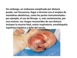 ANOXIA.MacrosomíaEl término es usado para describir el desarrollo o tamaño excesivo del cuerpo, como en el caso de un recién nacido con un peso por arriba del normal.La fisiopatología de la macrosomia está relacionada a la condición materna o a la condición del desarrollo fetal. Esta condición está fuertemente relacionada con la diabetes gestacional, en general cuando está mal controlada, así como en casos de obesidad en la madre y/o un aumento excesivo de peso en la madre.