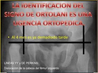 LuxacionCongenita de caderaDe cada 1000 ninosquenacen 12 estanexpuestos.De 12 luxadas o inestables. 6 se normalizaranespontaneamente en 8 a 10 dias.De cada 800 mill nacimientosporano, aproximadamente hay 4,800 luxacionescongenitas de cadera. 