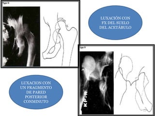 14 
LUXACION CON 
UN FRAGMENTO 
DE PARED 
POSTERIOR 
CONMINUTO 
LUXACIÓN CON 
FX DEL SUELO 
DEL ACETÁBULO 
 