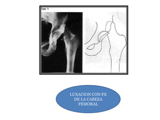 LUXACION CON FX 
DE LA CABEZA 
FEMORAL 
 
