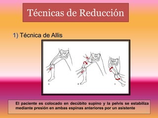 Técnicas de Reducción 
El paciente es colocado en decúbito supino y la pelvis se estabiliza 
mediante presión en ambas espinas anteriores por un asistente 
21 
1) Técnica de Allis 
 