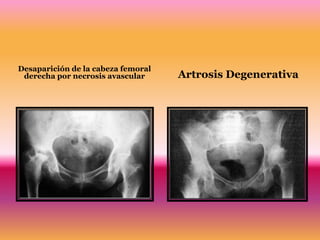 Desaparición de la cabeza femoral 
derecha por necrosis avascular Artrosis Degenerativa 
 