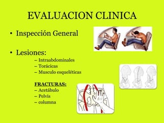 EVALUACION CLINICA 
• Inspección General 
• Lesiones: 
– Intraabdominales 
– Torácicas 
– Musculo esqueléticas 
FRACTURAS: 
– Acetábulo 
– Pelvis 
– columna 
 