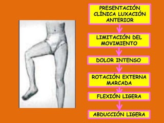 PRESENTACIÓN 
CLÍNICA LUXACIÓN 
ANTERIOR 
LIMITACIÓN DEL 
MOVIMIENTO 
DOLOR INTENSO 
ROTACIÓN EXTERNA 
MARCADA 
FLEXIÓN LIGERA 
ABDUCCIÓN LIGERA 
 