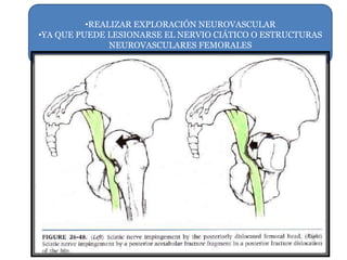 •REALIZAR EXPLORACIÓN NEUROVASCULAR 
•YA QUE PUEDE LESIONARSE EL NERVIO CIÁTICO O ESTRUCTURAS 
NEUROVASCULARES FEMORALES 
 
