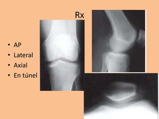 Rotula Axial Rx luxacion de rodilla y rotula para manejo | PPTX