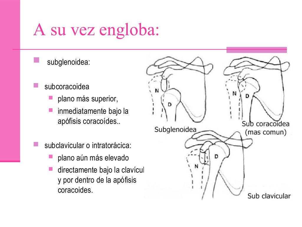 Luxacion anterior de hombro