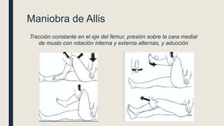 Maniobra de Allis
Tracción constante en el eje del fémur, presión sobre la cara medial
de muslo con rotación interna y externa alternas, y aducción
 