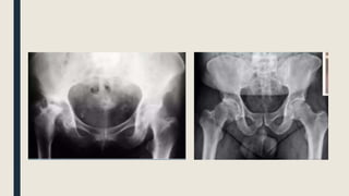 LUXACION CADERA.pptx