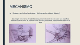 MECANISMO
■ Desgarro a nivel de la cápsula y del ligamento redondo (labrum)
La energía remanente elevada tras producirse la luxación puede hacer que la diáfisis
femoral actúe de brazo de palanca sobre el cuello provocando indirectamente fractura de
éste
 