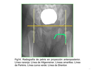 Fig14. Radiografía de pelvis en proyección anteroposterior.
Línea naranja: Línea de Hilgenreiner. Líneas amarillas: Línea
de Perkins. Línea curva verde: Línea de Shenton
17
 