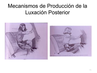 Mecanismos de Producción de la
Luxación Posterior
24
 