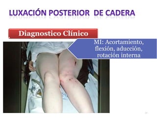 Diagnostico Clínico
MI: Acortamiento,
flexión, aducción,
rotación interna
31
 