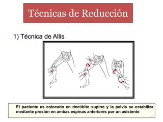 El paciente es colocado en decúbito supino y la pelvis se estabiliza
mediante presión en ambas espinas anteriores por un asistente
Técnicas de Reducción
37
1) Técnica de Allis
 