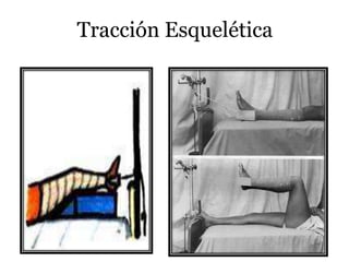 Tracción Esquelética
 
