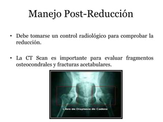 Manejo Post-Reducción
• Debe tomarse un control radiológico para comprobar la
reducción.
• La CT Scan es importante para evaluar fragmentos
osteocondrales y fracturas acetabulares.
 