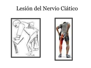 Lesión del Nervio Ciático
 
