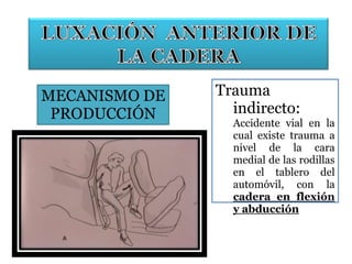 MECANISMO DE
PRODUCCIÓN
Trauma
indirecto:
Accidente vial en la
cual existe trauma a
nivel de la cara
medial de las rodillas
en el tablero del
automóvil, con la
cadera en flexión
y abducción
 