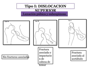 Tipo I: DISLOCACION
SUPERIOR
Fractura
asociada o
impactacio
n de
cabeza de
femur
Fractura
asociada al
acetábulo
Luxación púbica y subespinosa
Sin fracturas asociadas
 