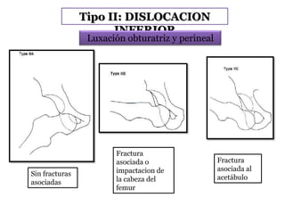 Tipo II: DISLOCACION
INFERIOR
Sin fracturas
asociadas
Fractura
asociada o
impactacion de
la cabeza del
femur
Fractura
asociada al
acetábulo
Luxación obturatriz y perineal
 