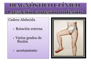 Cadera Abducida
• Rotación externa
• Varios grados de
flexión
• acortamiento
 