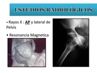 • Rayos X : AP y lateral de
Pelvis
• Resonancia Magnetica
 