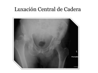 Luxación Central de Cadera
 