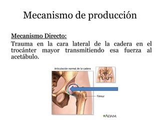 Mecanismo de producción
Mecanismo Directo:
Trauma en la cara lateral de la cadera en el
trocánter mayor transmitiendo esa fuerza al
acetábulo.
 