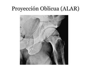 Proyección Oblicua (ALAR)
 