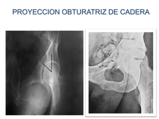 PROYECCION OBTURATRIZ DE CADERA
 
