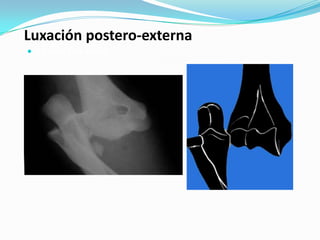 Luxación postero-externa
 La mas frecuente
 
