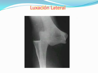 Luxación Lateral
 