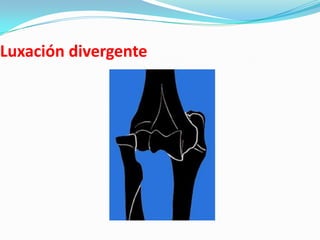 Luxación divergente
 