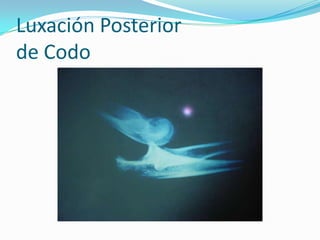 Luxación Posterior
de Codo
 