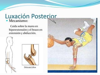 Luxación Posterior
 Mecanismo:
  Caída sobre la mano en
 hiperextensión y el brazo en
 extensión y abducción.
 